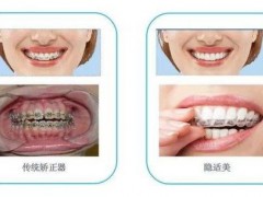 烤瓷牙修复后可能会出现的后果？