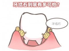 洗牙一般多久洗一次？