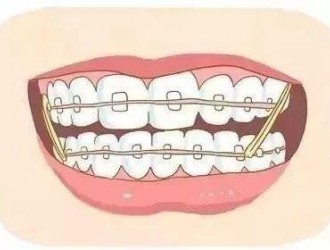 不戴牙套的牙齿矫正方法还有什么？