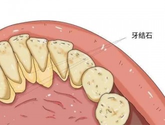 洗牙后会更容易长牙结石吗？