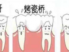 烤瓷牙好还是种植牙好？